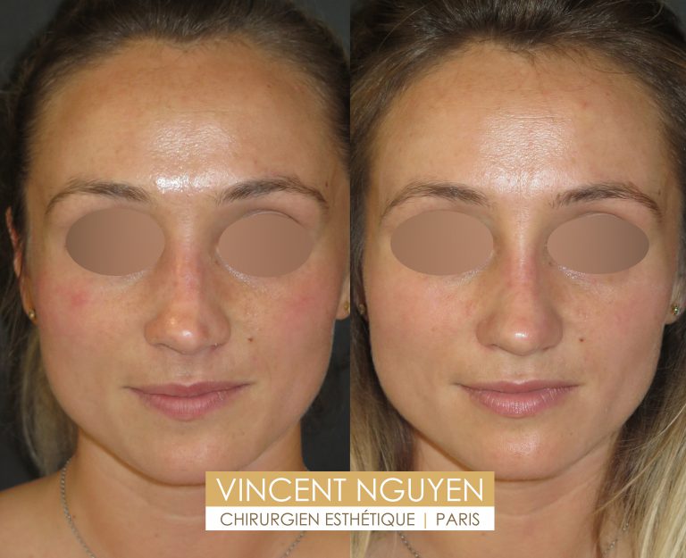 Rhinoplastie Médicale Sans Chirurgie Injection Acide Hyaluronique Nez